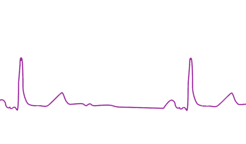 Hidas EKG